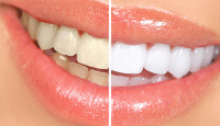 Dişleri Beyazlatma Yöntemleri